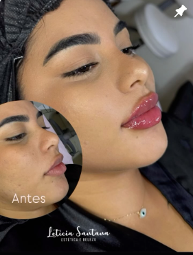 Preenchimento Labial